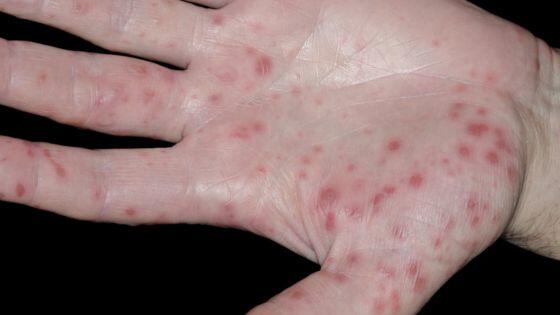 http://ichef-1.bbci.co.uk/news/560/media/images/67844000/jpg/_67844339_c0147980-hand,_foot_and_mouth_disease-spl.jpg